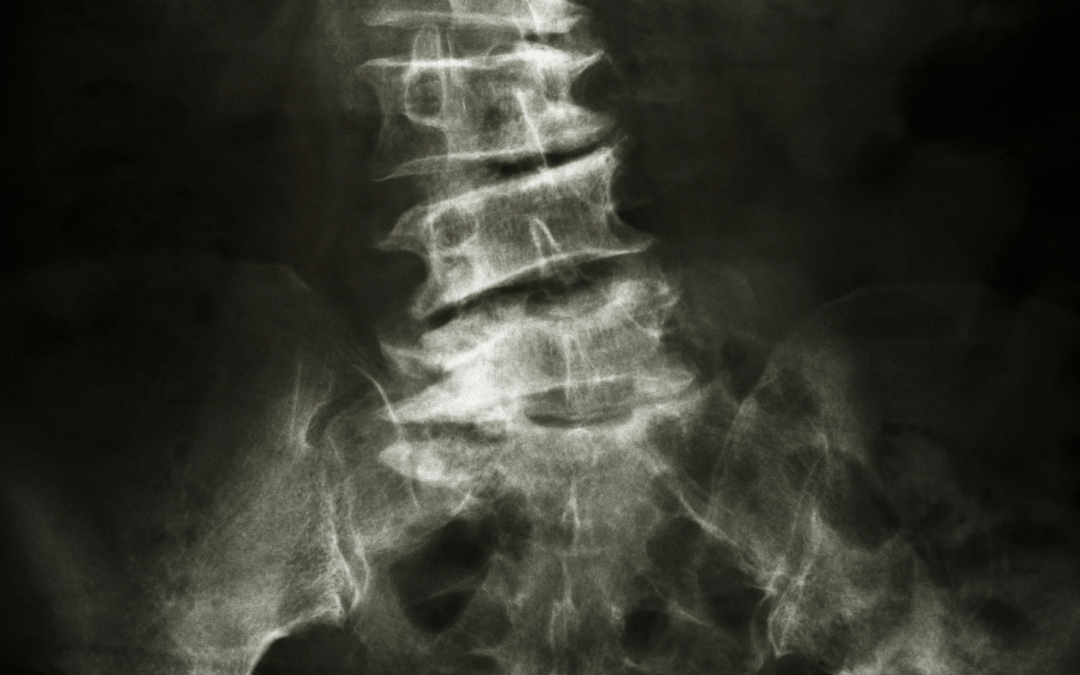 Atteggiamento scoliotico