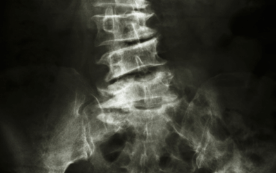 Atteggiamento scoliotico